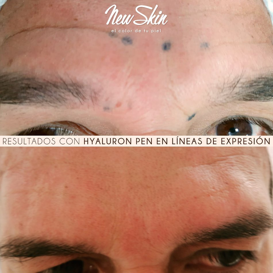 hyaluronpen4